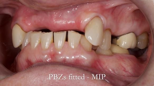 Newsletter 81 - Pam’s Story — how a partial denture changed her life (+ live walkthrough this Thursday)