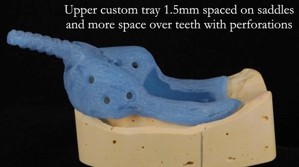Newsletter 56 showing the making and fitting of a bilateral free end saddle upper removable partial denture (RPD) for patient with pemphigus