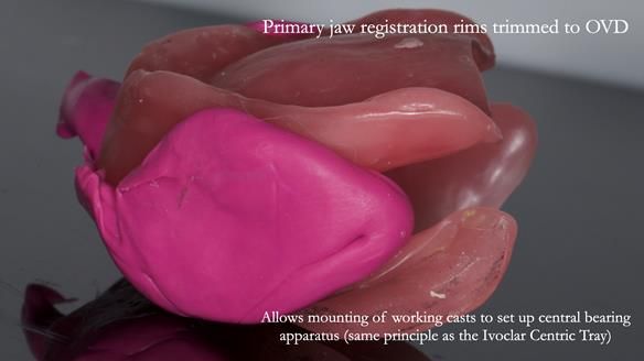 Newsletter 83: Sheila’s Complete Denture Success