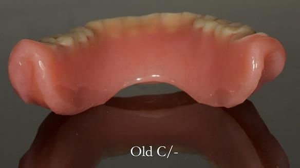 Complete denture Class II div 2 deep overbite Newsletter 39