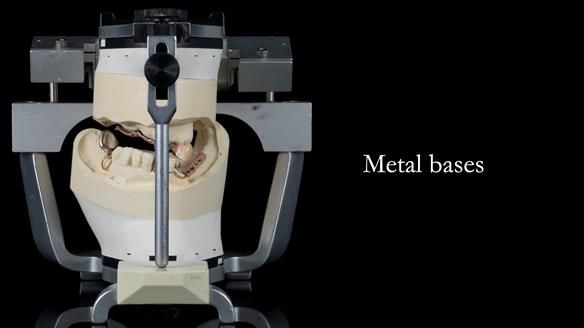 Newsletter 55 Provision of metal based partial dentures for Zephyrine with a repaired cleft lip and palate