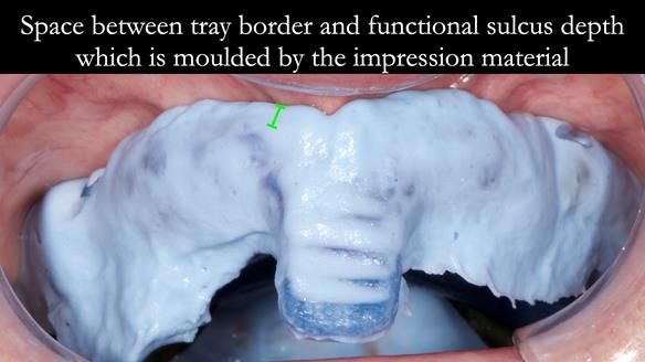 Newsletter 80 - Gordon’s dentures: the one case in 1,000 where my technique failed