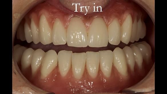 Note - irregularity of the lower anterior teeth - to make them more real/lifelike