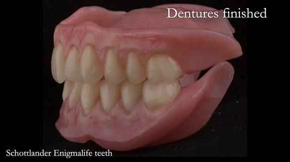 Newsletter 75: Marion’s case - Step-by-step complete denture workflow