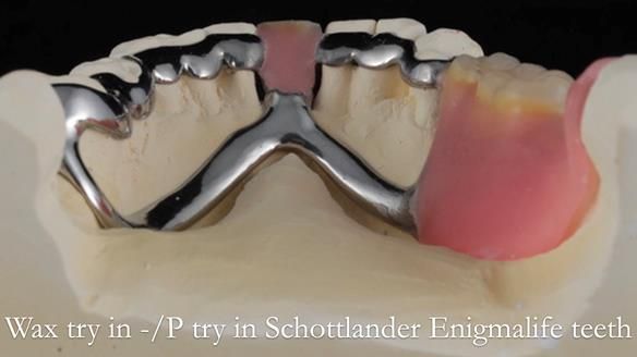Newsletter 54 case presentation upper complete denture and lower Scandinavian designed hygienic partial denture for David
