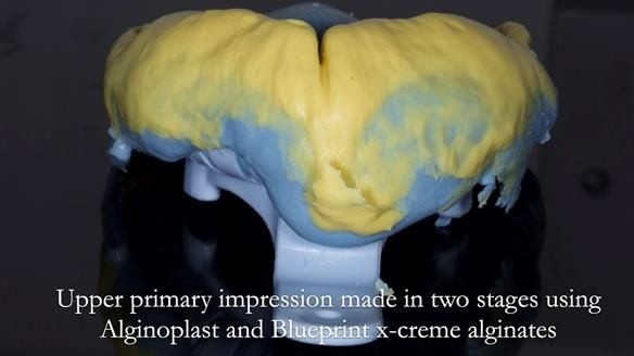 Newsletter 54 case presentation upper complete denture and lower Scandinavian designed hygienic partial denture for David