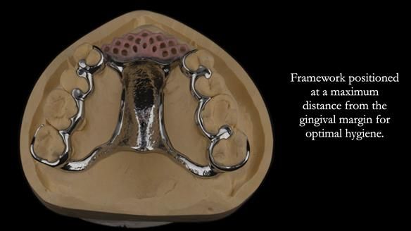 Finlay's Newsletter 63 Case study provision of metal based Scandinavian RPD - functional 10 years on
