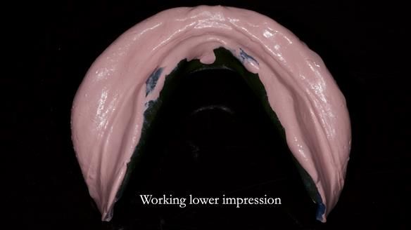 Newsletter 83: Sheila’s Complete Denture Success