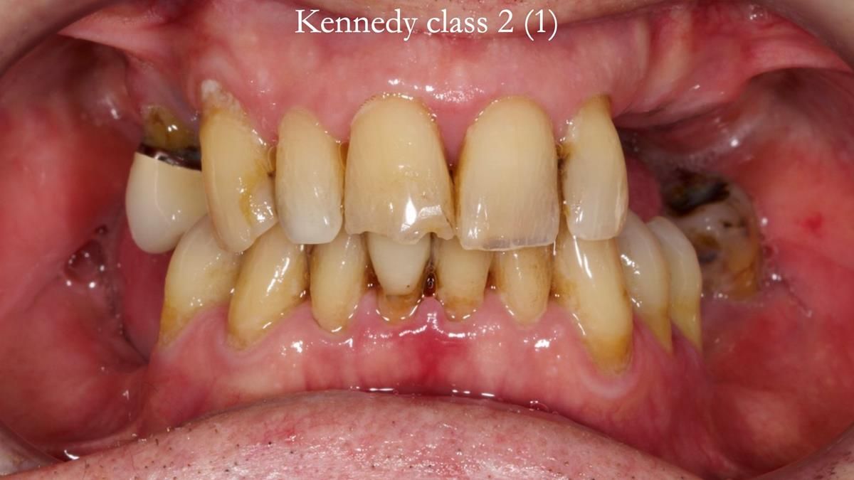 Newsletter 89 – Simon: A Challenging Kennedy Class II Division 1 Upper CoCr Partial Denture with a High Smile Line