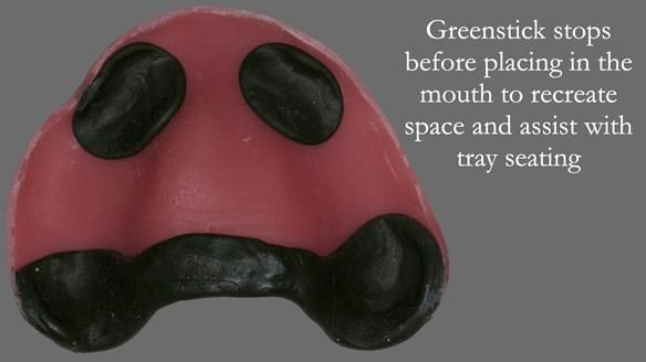 Newsletter 52 Managing Jo’s failing dentition with extractions and Mk 1/Mk 2 complete upper dentures and lower partial dentures FULL PROTOCOL