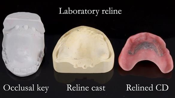 Finlay's Newsletter 62 provision of extractions and metal based complete dentures for Rafique