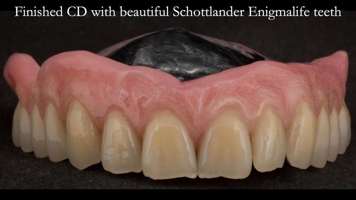 Newsletter 87 – Father Peter: A Partial Denture that needed Minor Miracle
