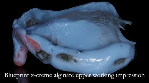 Newsletter 52 Managing Jo’s failing dentition with extractions and Mk 1/Mk 2 complete upper dentures and lower partial dentures FULL PROTOCOL