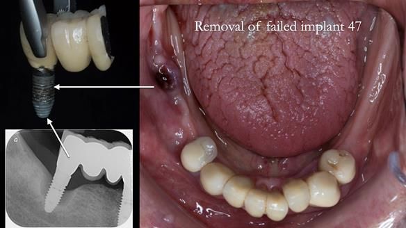 Ken – going downhill, first class