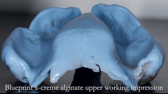 Newsletter 77: Jeremy’s case – immediate complete upper denture