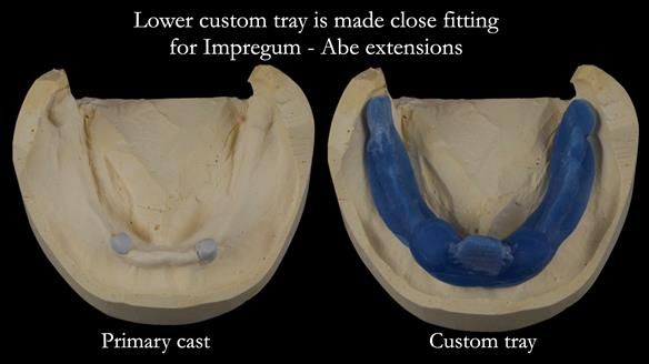 Newsletter 57 showcases the making and fitting process of implant-supported complete dentures for Alisdair