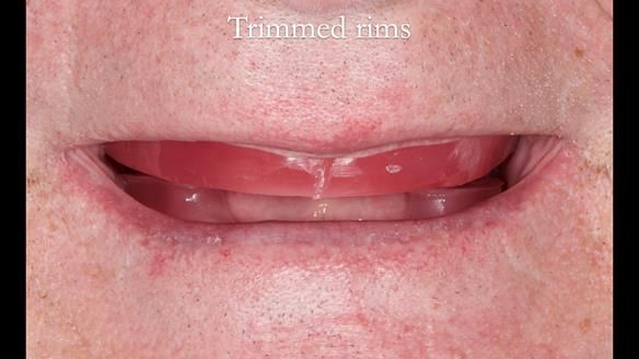 Complete denture Class II div 2 deep overbite Newsletter 39