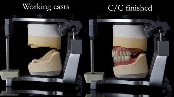 Managing poor implant positioning with complete dentures and Locator attachments - full protocol Newsletter 41
