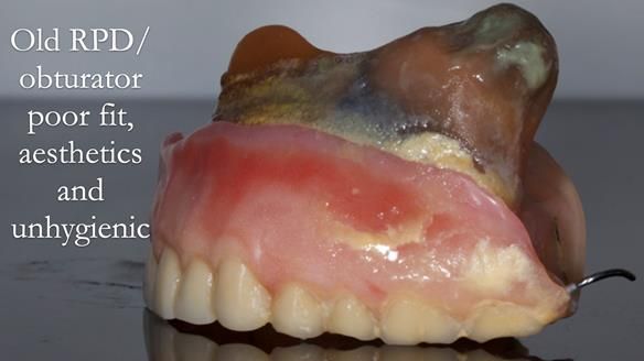 Upper metal base partial denture/occlusal stabilisation splint/obturator - full protocol