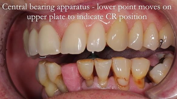 Newsletter 54 case presentation upper complete denture and lower Scandinavian designed hygienic partial denture for David