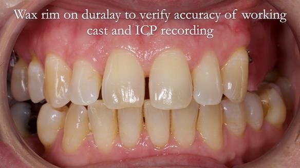 Solving Sue's failed implants with metal based RPD - full protocol Newsletter 43