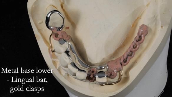 Newsletter 55 Provision of metal based partial dentures for Zephyrine with a repaired cleft lip and palate