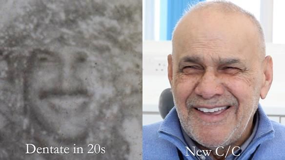 Managing poor implant positioning with complete dentures and Locator attachments - full protocol Newsletter 41