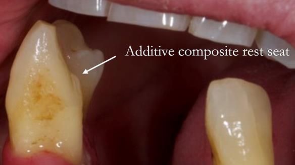 Finlay's Case Study Newsletter 40 - Immediate Mk 1 RPD to Definitive Mk 2 RPD - full protocol