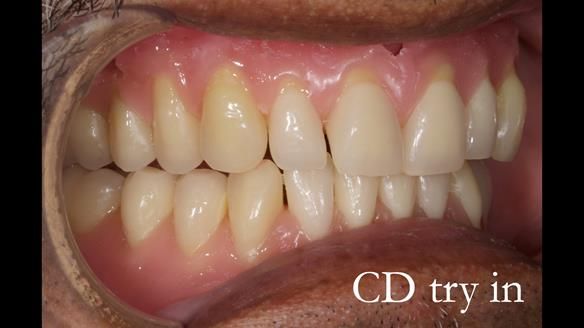 Finlay's Newsletter 62 provision of extractions and metal based complete dentures for Rafique