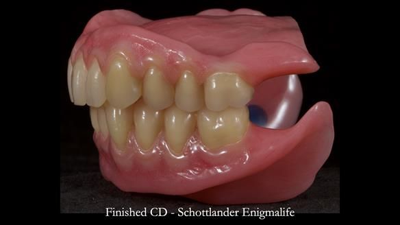 Newsletter 83: Sheila’s Complete Denture Success