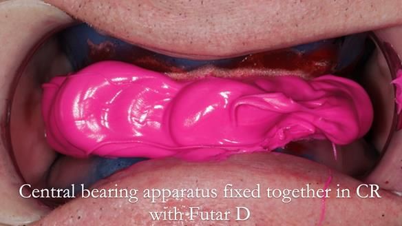 Newsletter 57 showcases the making and fitting process of implant-supported complete dentures for Alisdair