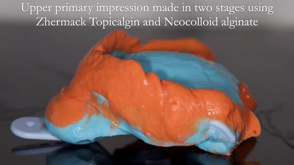 Managing poor implant positioning with complete dentures and Locator attachments - full protocol Newsletter 41