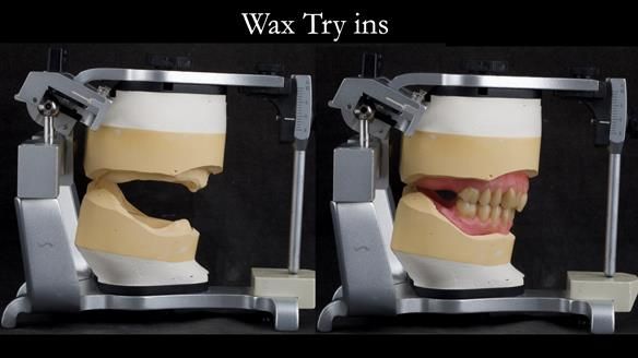 Complete denture Class II div 2 deep overbite Newsletter 39