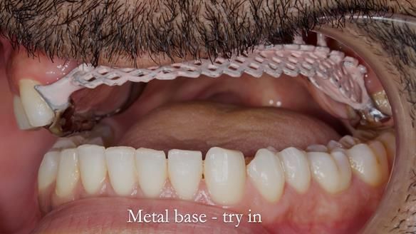 Upper metal base partial denture/occlusal stabilisation splint/obturator - full protocol