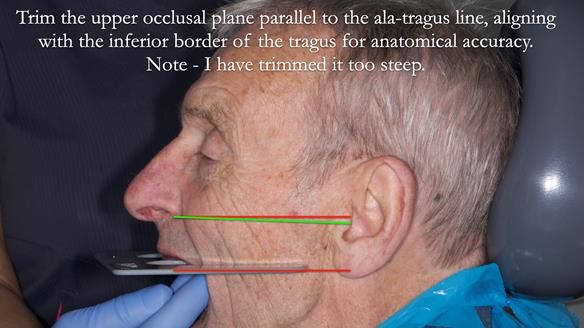 Newsletter 80 - Gordon’s dentures: the one case in 1,000 where my technique failed