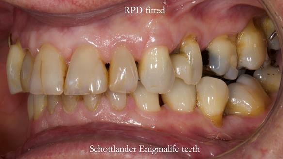 Finlay's Newsletter 64 case study - provision of a Kennedy class 2 metal based Scandinavian RPD for Ian