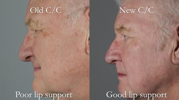 Newsletter 57 showcases the making and fitting process of implant-supported complete dentures for Alisdair