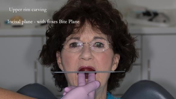 Newsletter 75: Marion’s case - Step-by-step complete denture workflow