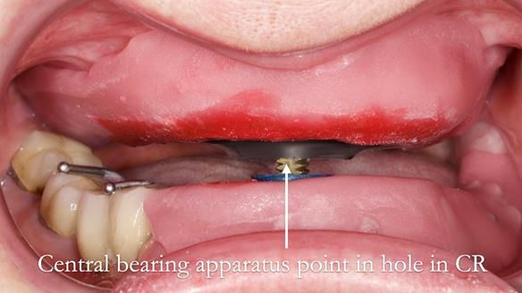 Newsletter 82 Mary - A complete upper and a one-tooth gasket denture
