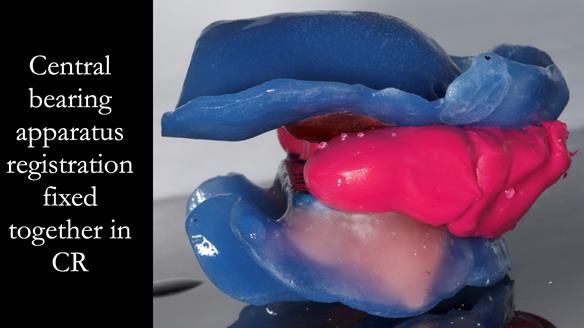 Finlay's Newsletter 62 provision of extractions and metal based complete dentures for Rafique