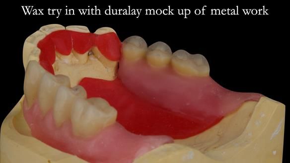 Finlay's Case Study Newsletter 40 - Immediate Mk 1 RPD to Definitive Mk 2 RPD - full protocol