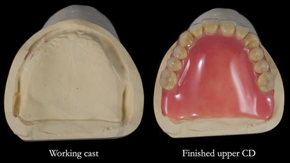 Newsletter 83: Sheila’s Complete Denture Success