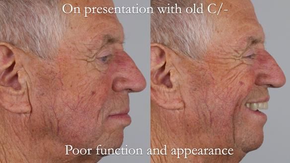 Newsletter 54 case presentation upper complete denture and lower Scandinavian designed hygienic partial denture for David