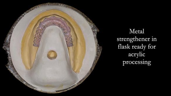 Managing poor implant positioning with complete dentures and Locator attachments - full protocol Newsletter 41
