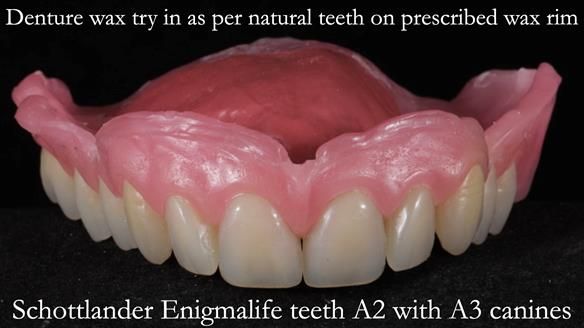 Finlay's Newsletter 58 Gasket upper partial denture for Zoe
