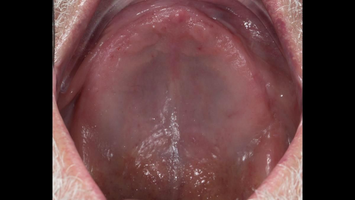 Newsletter 87 – Father Peter: A Partial Denture that needed Minor Miracle
