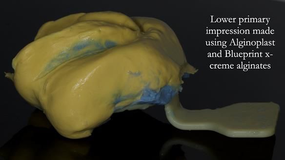 Newsletter 83: Sheila’s Complete Denture Success