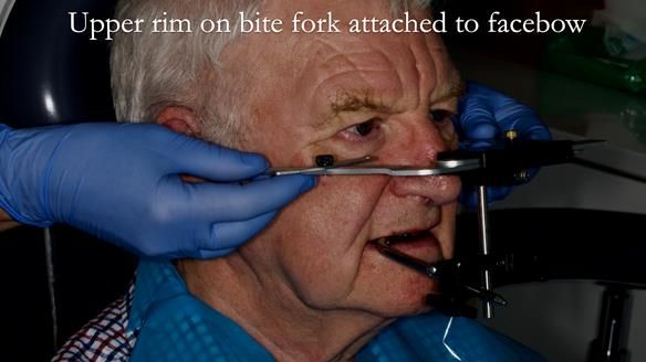 Newsletter 57 showcases the making and fitting process of implant-supported complete dentures for Alisdair