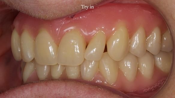 Newsletter 82 Mary - A complete upper and a one-tooth gasket denture