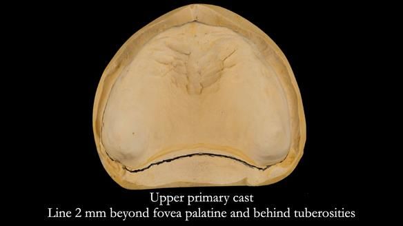Managing poor implant positioning with complete dentures and Locator attachments - full protocol Newsletter 41